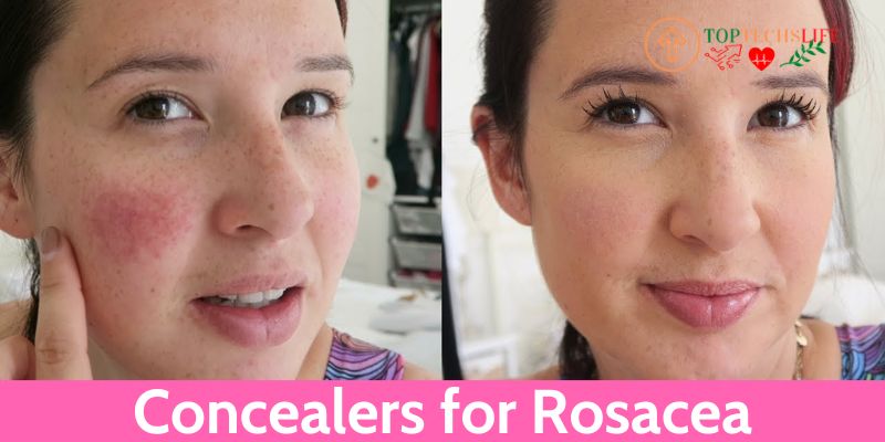 Concealers for Rosacea