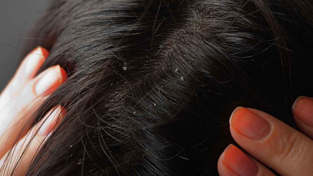 Hair Problems - Dandruff